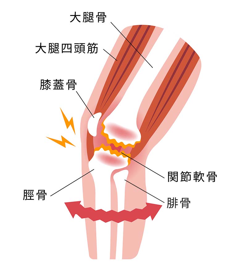 膝の痛み説明画像